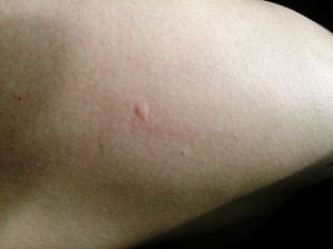 Mosquito_bite